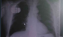 Uzmanından kalp pili taşıyanlara soğuk hava uyarısı