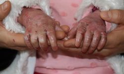 Kelebek hastalığı kadınlarda 9 kat fazla görülüyor