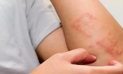 Çocukluk çağında döküntülü hastalıklar sık görülür