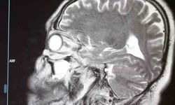 Prof. Dr. Erol: "Beyin tümörleri her yaşta görülebiliyor"