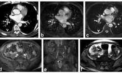 Akciğer damarındaki pıhtıların tanısında radyasyonsuz çözüm