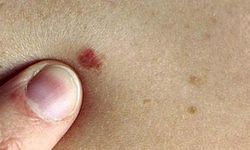 Derideki masum görünen benlere dikkat!