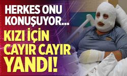 Kızı için cayır cayır yandı!
