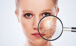 Kışın düşen D vitamini cilt hastalıklarını alevlendiriyor