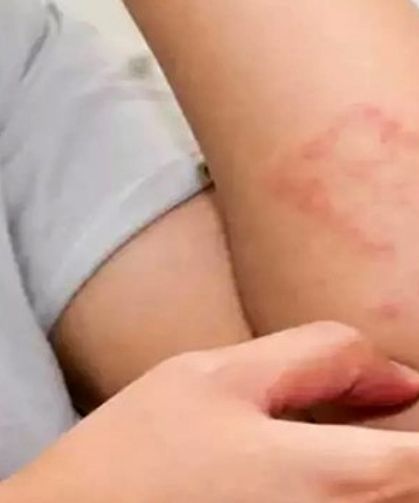 Alerjilerini öğrenen hastalar daha konforlu bir yaşam sürüyor