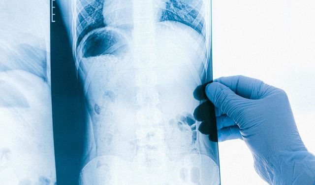 "Son 5 yılda akciğer kanseri görülme sıklığı yüzde 15 arttı"