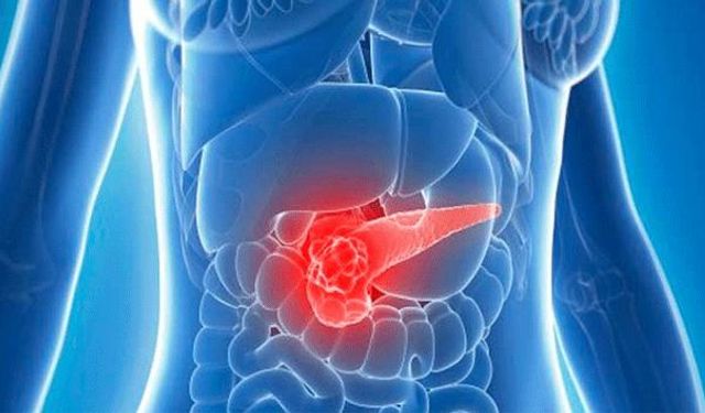 Uzmanı pankreas kanserine karşı uyardı