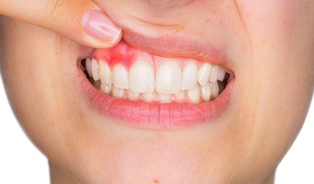 "Kanal tedavisindeki gecikme kistlere sebep olabilir"