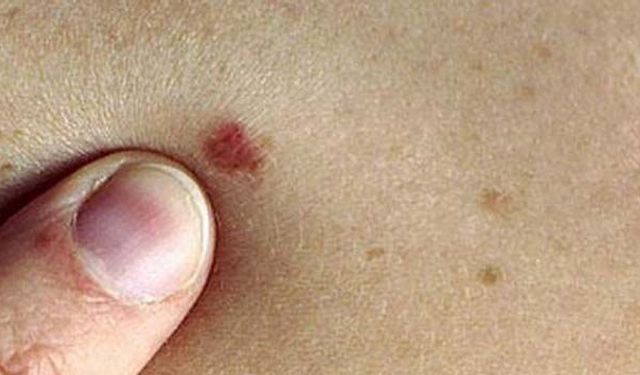 Derideki masum görünen benlere dikkat!