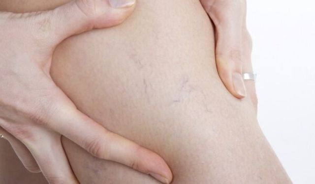 Uzmanından varis hastalığı uyarısı!