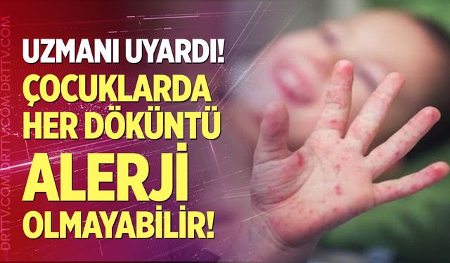 Çocuklarda görülen her döküntü alerji olmayabilir!
