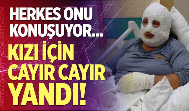 Kızı için cayır cayır yandı!