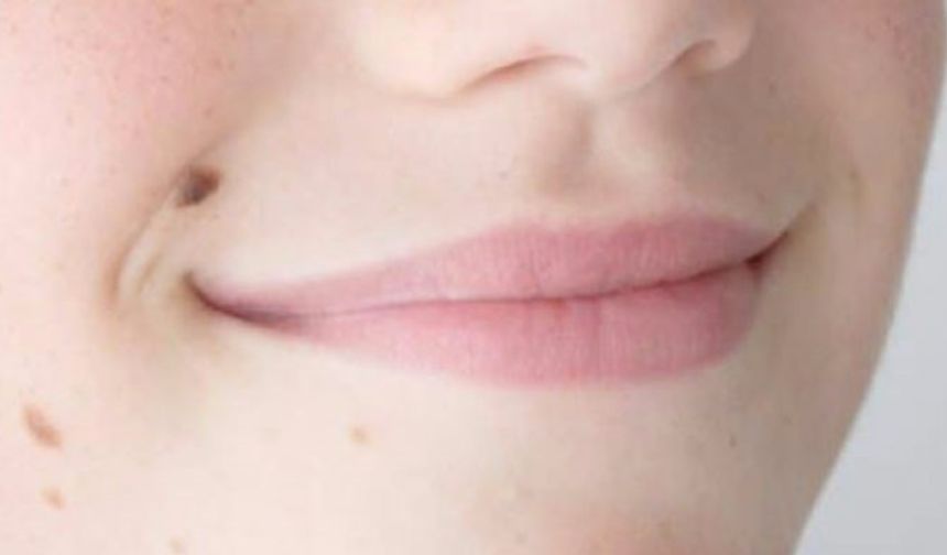 ’Ben’ler sadece cerrahi yolla çıkarılmalı