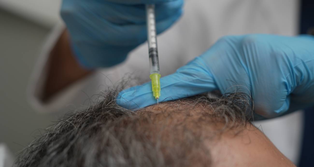 Denizli Haber Dökülen Saçlar Vücudun Bir Alarmı Olabilir