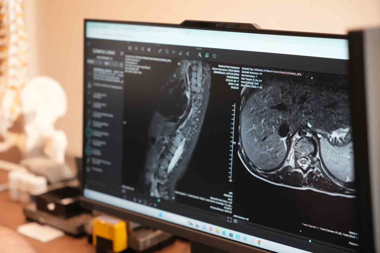 Denizli Haber Skolyoz2-3