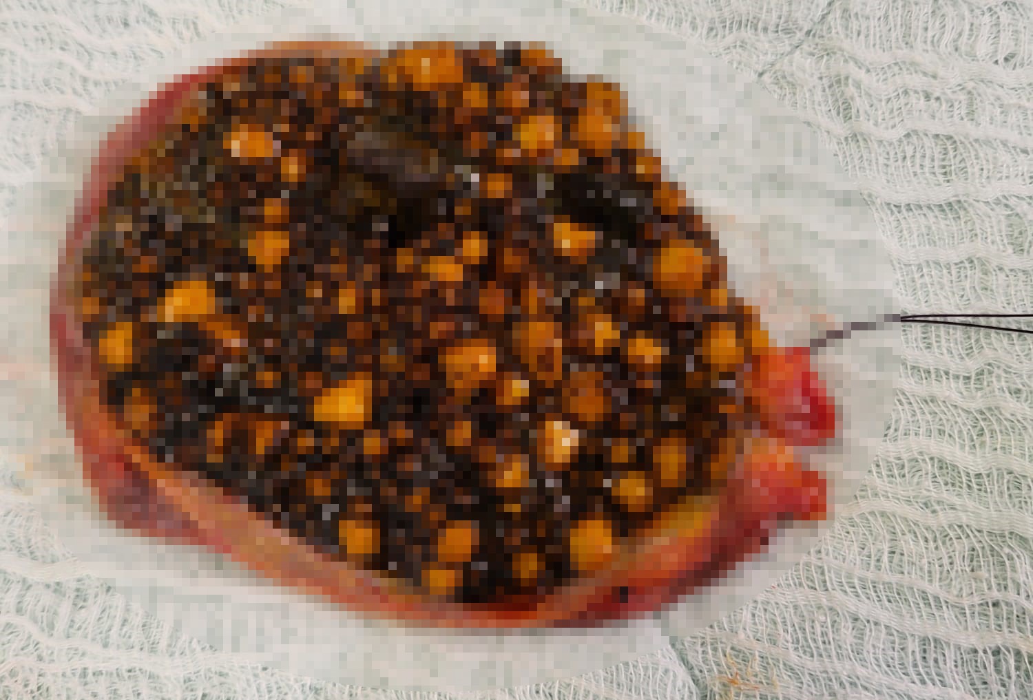 Doktorlar Şaşkına Döndü! Karın Ağrısıyla Gitti, Safrasından Binlerce Taş Çıktı.. (2)