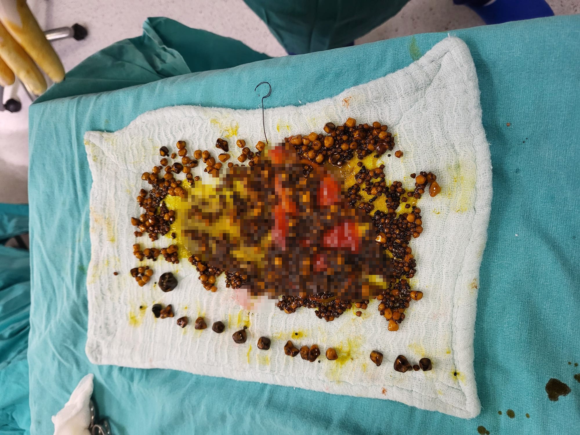 Doktorlar Şaşkına Döndü! Karın Ağrısıyla Gitti, Safrasından Binlerce Taş Çıktı.. (3)