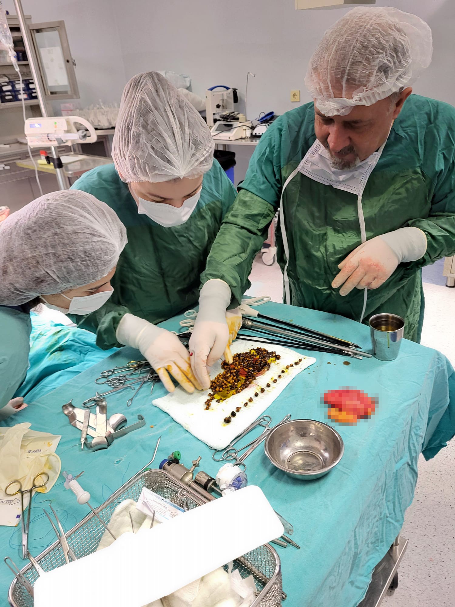 Doktorlar Şaşkına Döndü! Karın Ağrısıyla Gitti, Safrasından Binlerce Taş Çıktı.. (4)