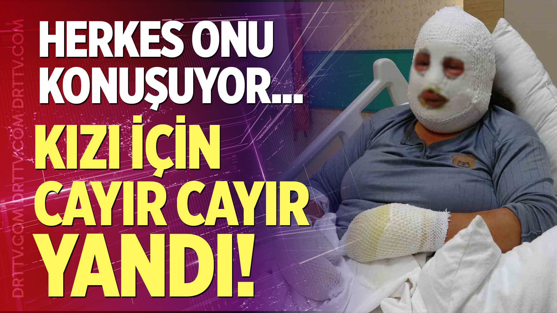 Kızı için cayır cayır yandı!